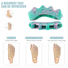 HYGGEAR Big Toe Bunion (Hallux Valgus) Corrector