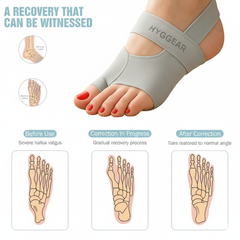 HYGGEAR Big Toe Bunion (Hallux Valgus) Corrector  - 52438576887